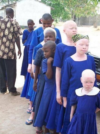 Pentru aceasta, albinosii din Tanzania sunt tăiați în bucăți, blogul interpretului