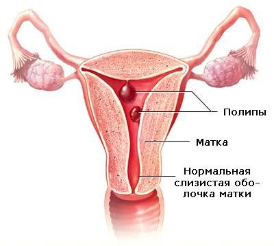 Glandular polipi cauze endometriale, simptome, tratament