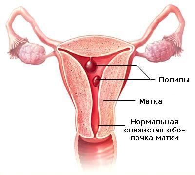 Залозистий поліп ендометрія причини, симптоми, лікування