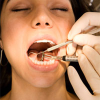 Зуб мудрості стоматологія