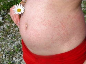 Алергія на сонце - симптоми, фото, лікування, що робити при алергії на сонце