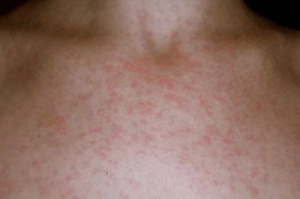 Allergia a nap - jelek, képek, kezelés, mi a teendő, ha allergiás a nap