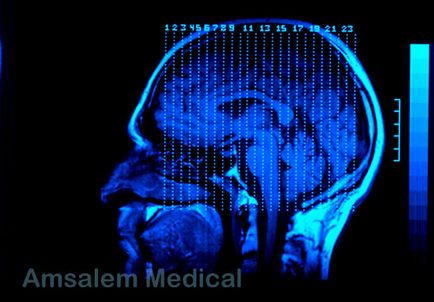 Anaplastikus oligodendroglioma (ao)