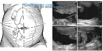 Indicele anatomic al lichidului amniotic, lichidul amniotic