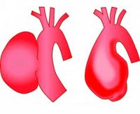 Anevrismul arcului aortic - cauze, simptome, diagnostic și tratament