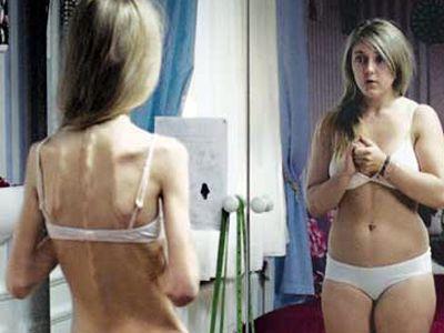 Fetele anorexice sunt elegante sau dezgustatoare