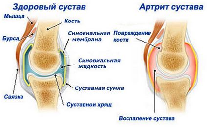 Артрит колінного суглоба симптоми і лікування, причини захворювання