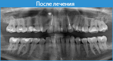 Атипове видалення зуба мудрості