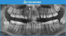 Атипове видалення зуба мудрості