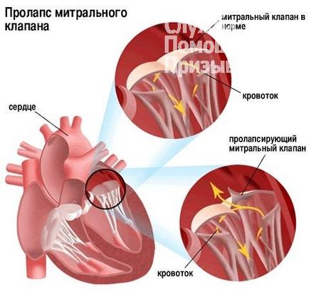 Чи беруть в армію з пролапсом, служба допомоги призовникам