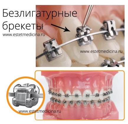 Безлігатурні (самолігуючі) брекети плюси, мінуси, ціни, інтернет-журнал