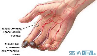 Brujer cauza cauzei grutz, simptome, tratament, formă ușoară și severă, etape, diagnostic