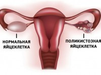 Borovaya méh függelékek gyulladás hogyan kezelje adnexitis