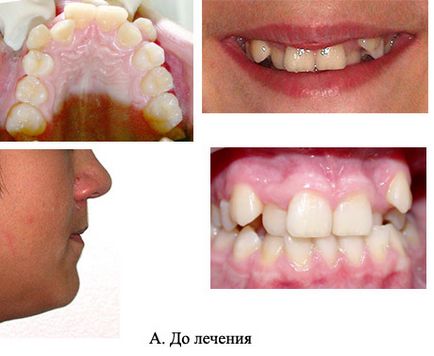 Brackets damon, centru orthodontic orthoservice