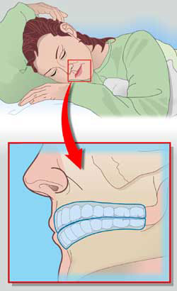 Бруксизм, симптоми бруксизма і бруксизм уві сні, інформація центру здоров'я порожнини рота