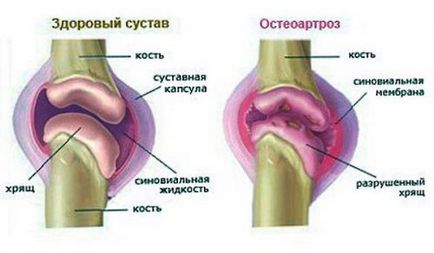 Bursita mâinii (inflamarea sacului comun)