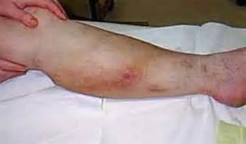 Ce este periculos pentru venele varicoase pe membrele inferioare, sănătatea articulațiilor