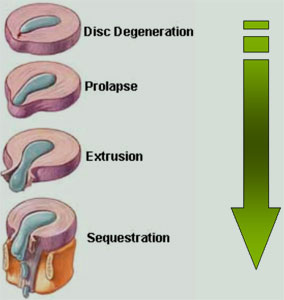 Діагностика міжхребцевої протрузії диска - клініка доктора Ігнатьєва г