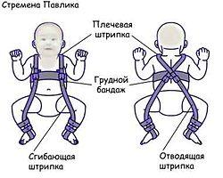 Дисплазія тазостегнових суглобів у дітей фото, лікування, наслідки ДТЗ - my life