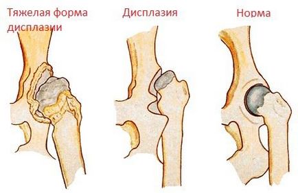 Displazia articulațiilor de șold la copii, tratament, efecte dts - viața mea