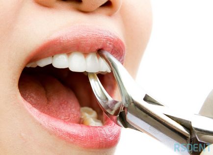 Extirparea dintelui (extracția dinților), rsdent