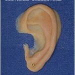 Екзопротезірованіе особи - лицьове протезування, протезування вуха, вушної раковини,