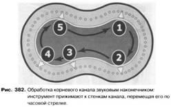 Ендодонтичні наконечники і машинні інструменти для розширення і вирівнювання кореневих каналів