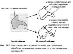 Vârfuri endodontice și mașini-unelte pentru extinderea și alinierea canalelor radiculare