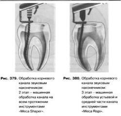 Vârfuri endodontice și mașini-unelte pentru extinderea și alinierea canalelor radiculare