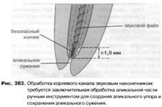 Ендодонтичні наконечники і машинні інструменти для розширення і вирівнювання кореневих каналів