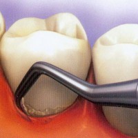 Estetica stomatologică tipuri de corectare a defectelor vizuale ale dinților