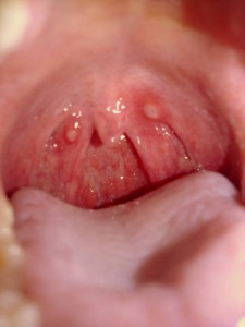Faringita - simptome, cauze și remedii folclorice pentru faringită