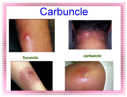 Фурункул і карбункул причини, стадії, симптоми, лікування