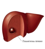 Hemangiomul organelor interne, tratamentul hemangiomului hepatic și îndepărtarea tumorii pe coloană vertebrală