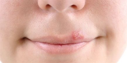 Herpes - un articol inofensiv sau periculos