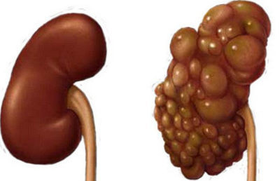 Hiperfromul rinichiului ce este, simptomele și prognosticul