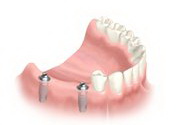 Implantarea dinților în Austria, tratament în Austria, stomatologie în Austria