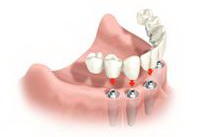 Implantarea dinților în Austria, tratament în Austria, stomatologie în Austria