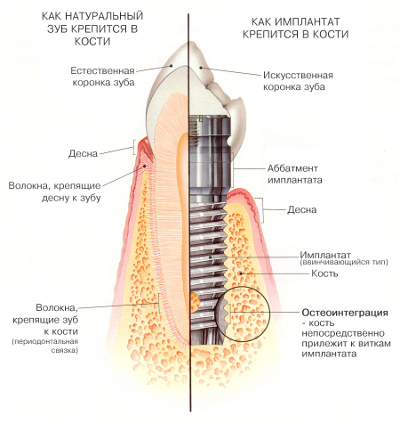 Імплантація зубів в Москві