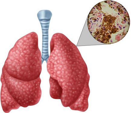 Perioada de incubație a tuberculozei, tratament și prevenire