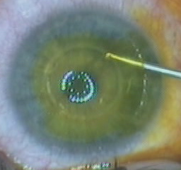 Implantarea intrastromă a miorei inelului, microchirurgia mntk a ochiului im