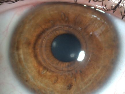 Implantarea intrastromă a miorei inelului, microchirurgia mntk a ochiului im
