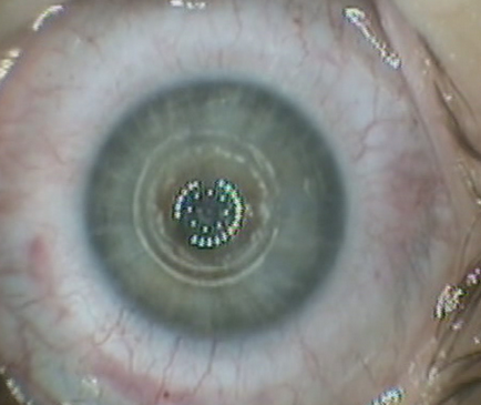 Інтрастромальний імплантація кільця myoring, МНТК «мікрохірургія ока» ім