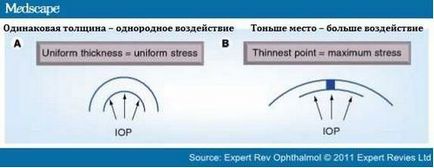 Інтрастромальний рогівкові кільця хвороби очей