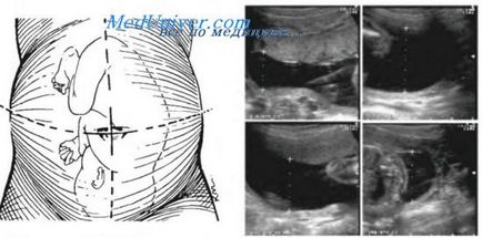 Studiu de placentă, cordon ombilical și lichid amniotic în uzi
