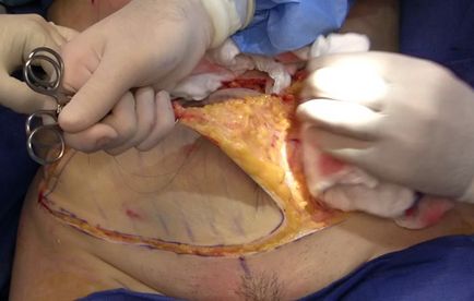 Cum se face abdominoplastia în abdomen