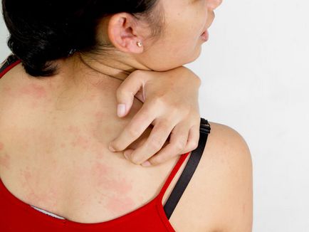 Яким гелем лікувати алергію на шкірі
