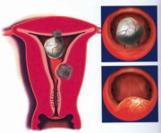 Як визначити міому матки самостійно і по аналізах