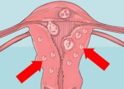 Як визначити міому матки самостійно і по аналізах