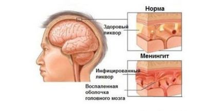 Як передається менінгіт, чи можна їм заразитися